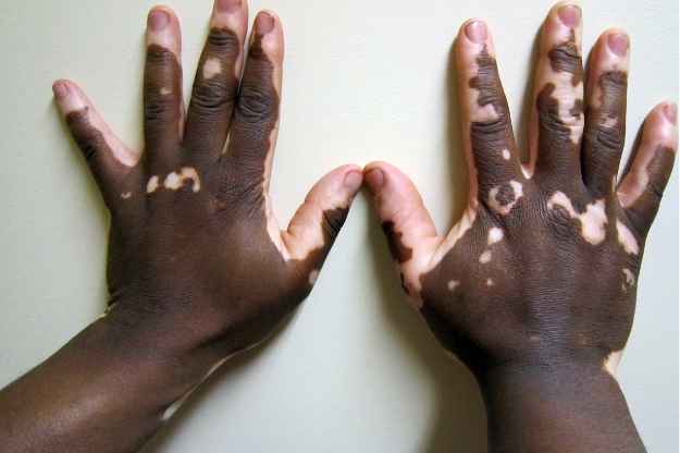 Bimwe mu bimera byafasha umuntu ufite ikibazo cy’uruhu ruzaho amabara ‘Vitiligo’